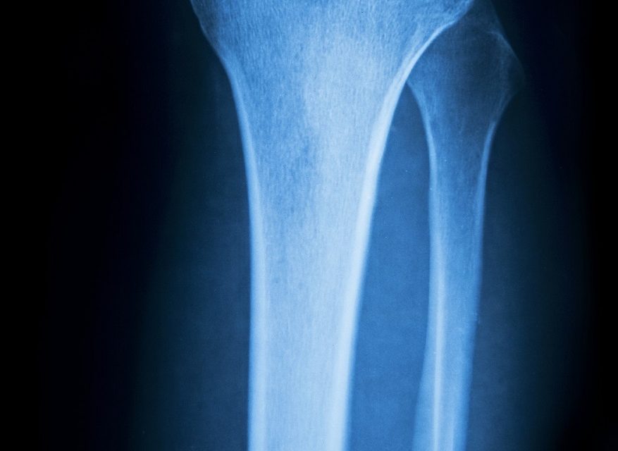 New billing model aims to improve care, lower costs for joint replacements