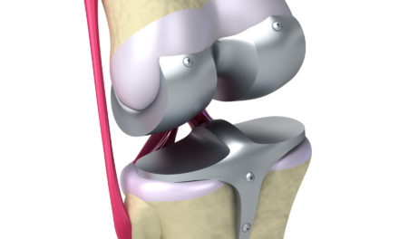 Are Obese Patients Good Candidates for Knee Replacement?