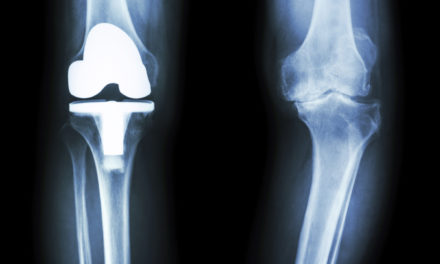Healthy over 60: Knee, hip replacement surgery skyrockets