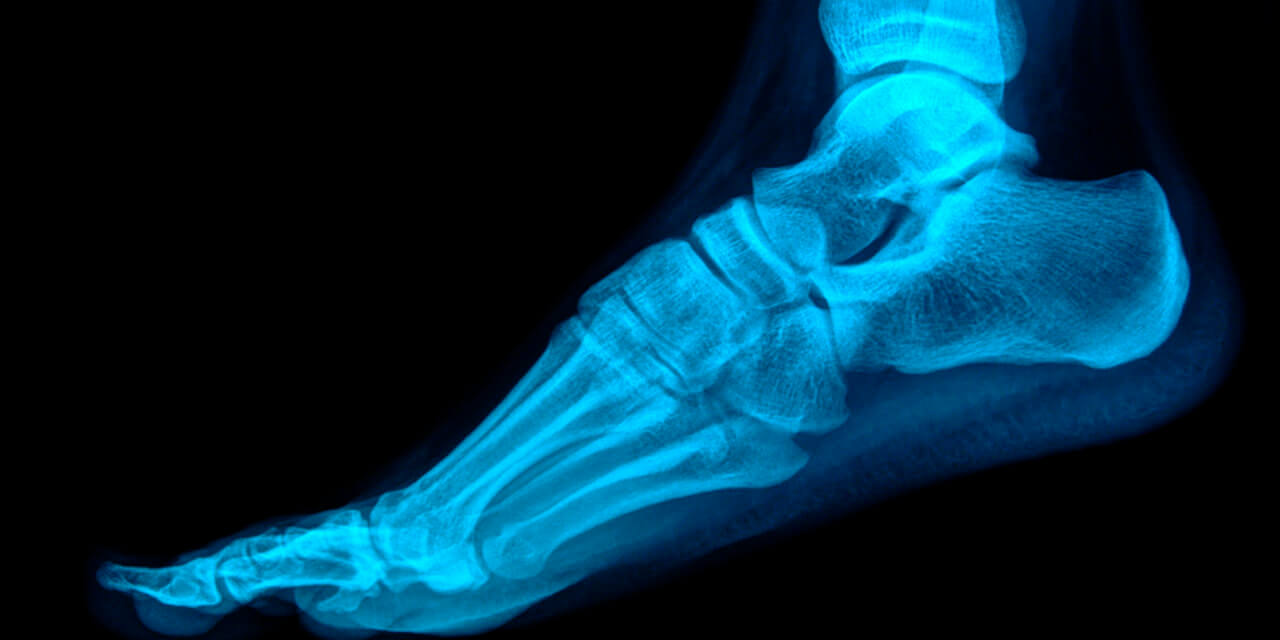 Ankle replacement surgery brings relief for local patients suffering from pain